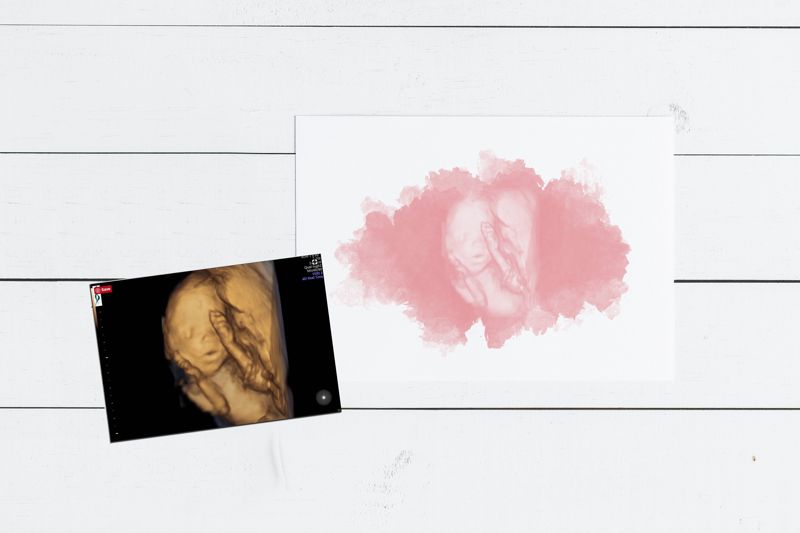 Watercolor Ultrasound Art with Two Images